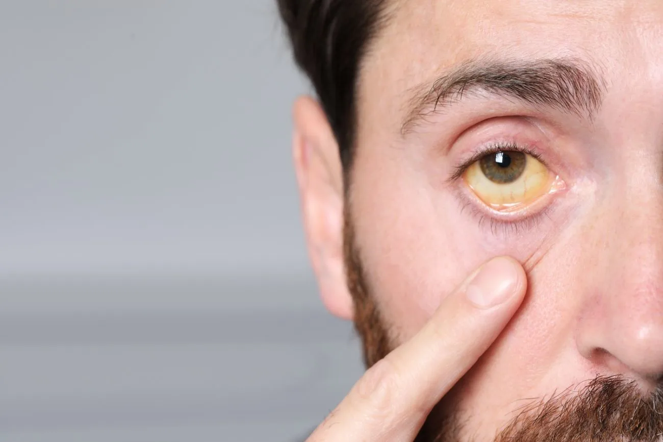 jaundice symptoms in Hindi 